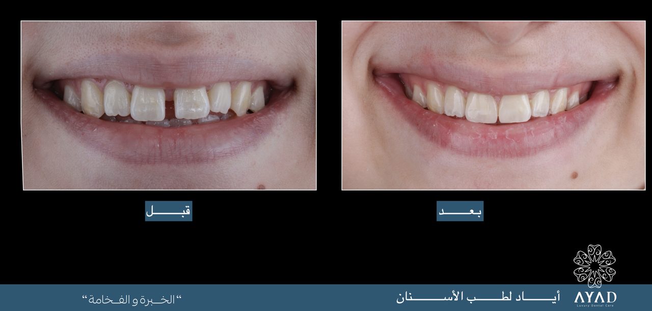 Case card — a gap between the upper front teeth closed, before and after
