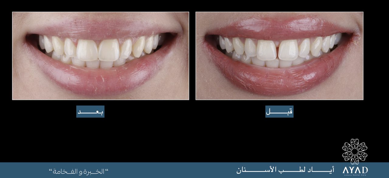 Case card — a smile evened and brightened, shown before and after