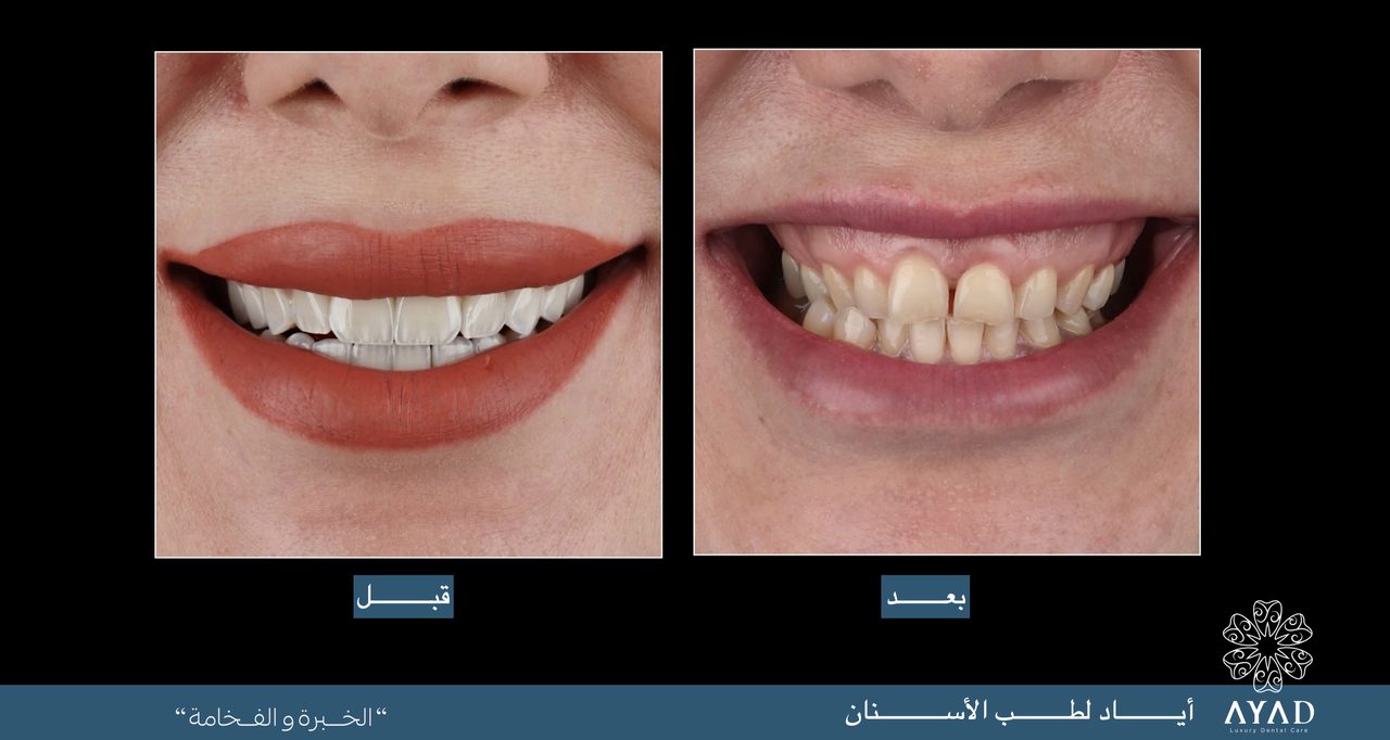 Case card — crowded upper front teeth aligned, before and after