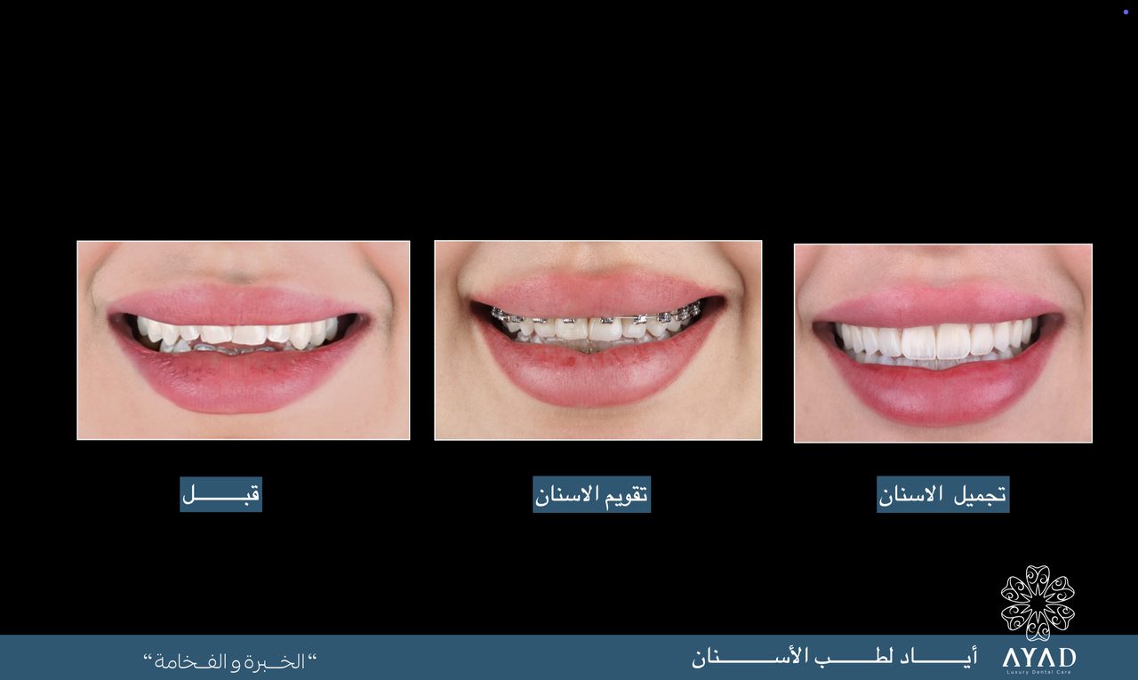 Case card — three stages of one smile: before, in braces, and after the aesthetic work