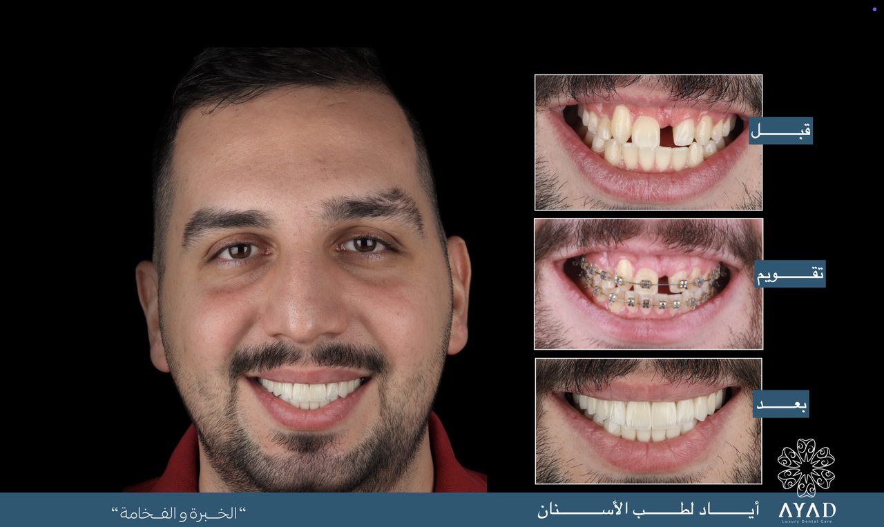 Case card — a portrait beside three stages: the missing tooth, the braces, and the result