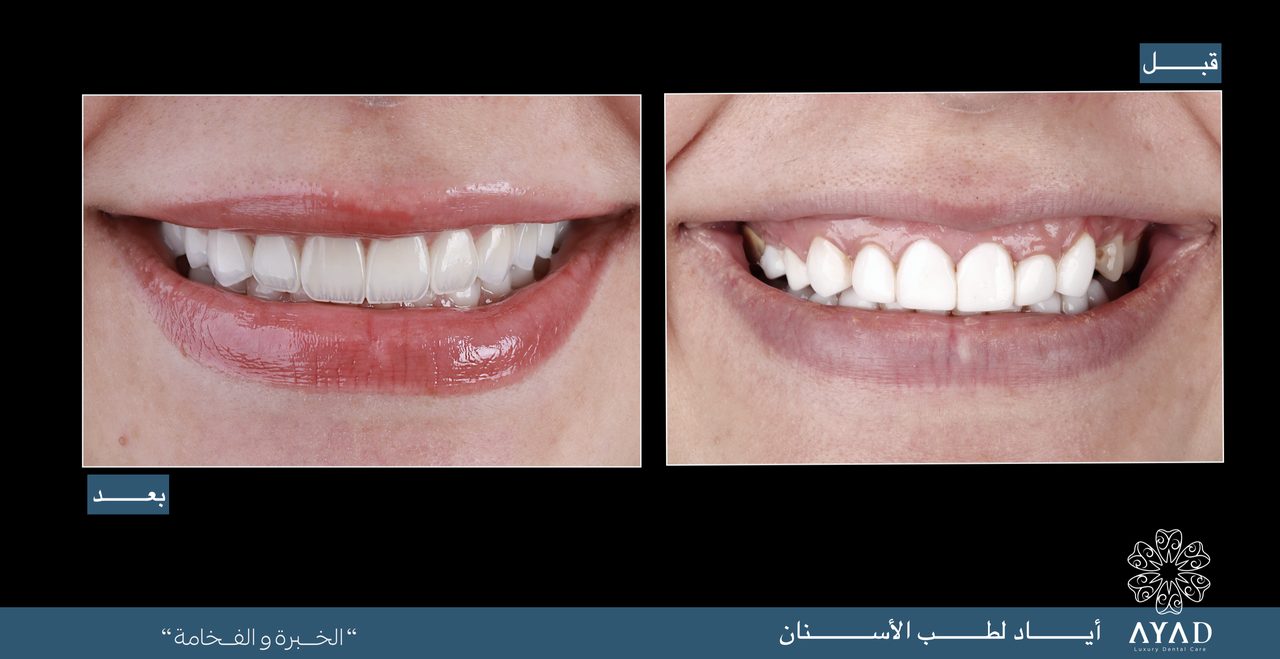 Case card — two close studies of the same smile, before and after
