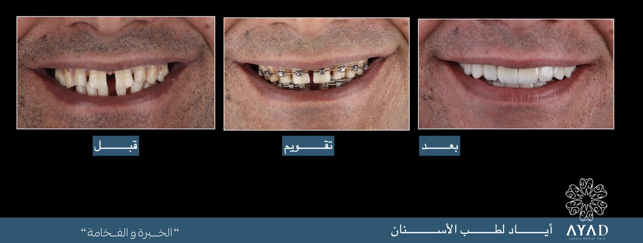 Case card — three stages of a smile: before, in braces, and after