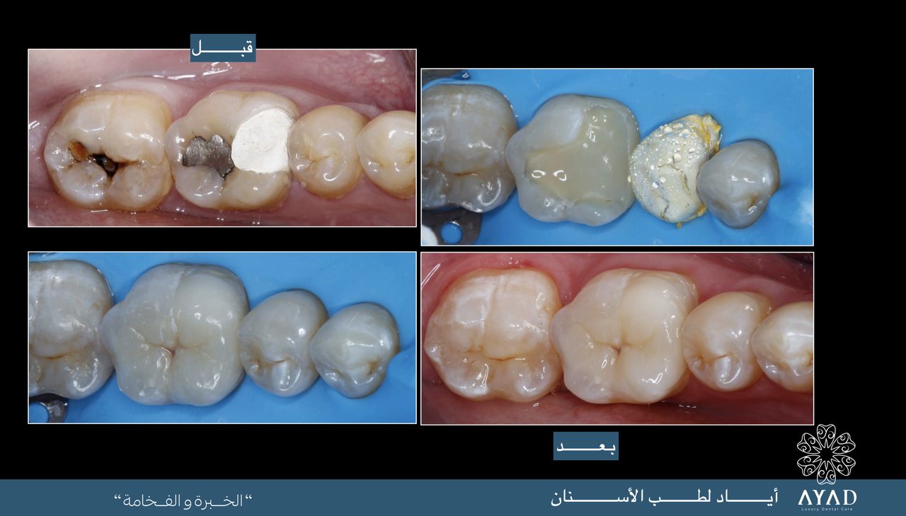 Case card — a decayed molar restored, with the work in progress under a dam