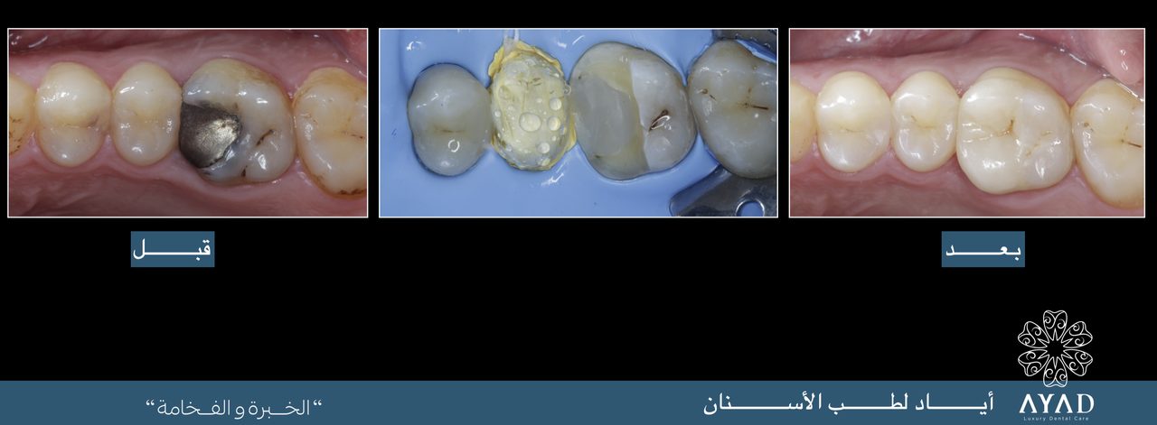 Case card — a molar rebuilt in composite, shown before, during and after