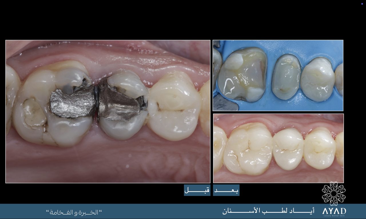 Case card — two molars with old amalgam fillings, replaced and finished