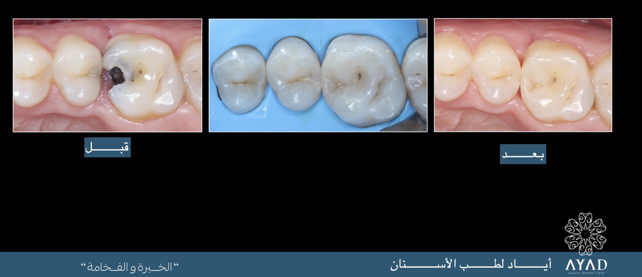 Case card — decay cleared from a molar and the tooth rebuilt