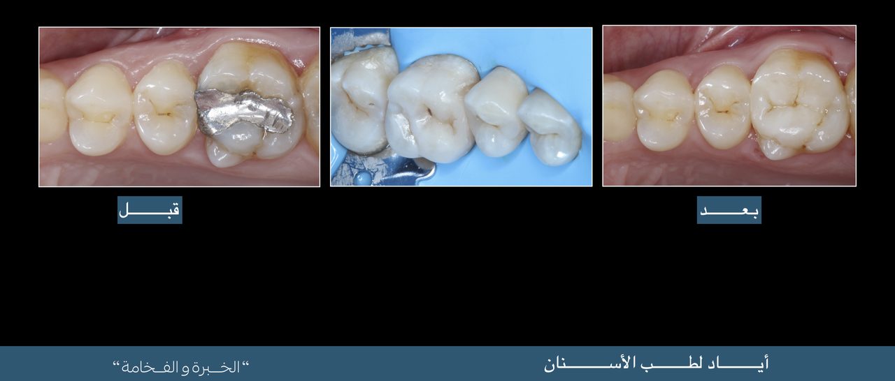 Case card — an amalgam filling replaced with a tooth-coloured restoration