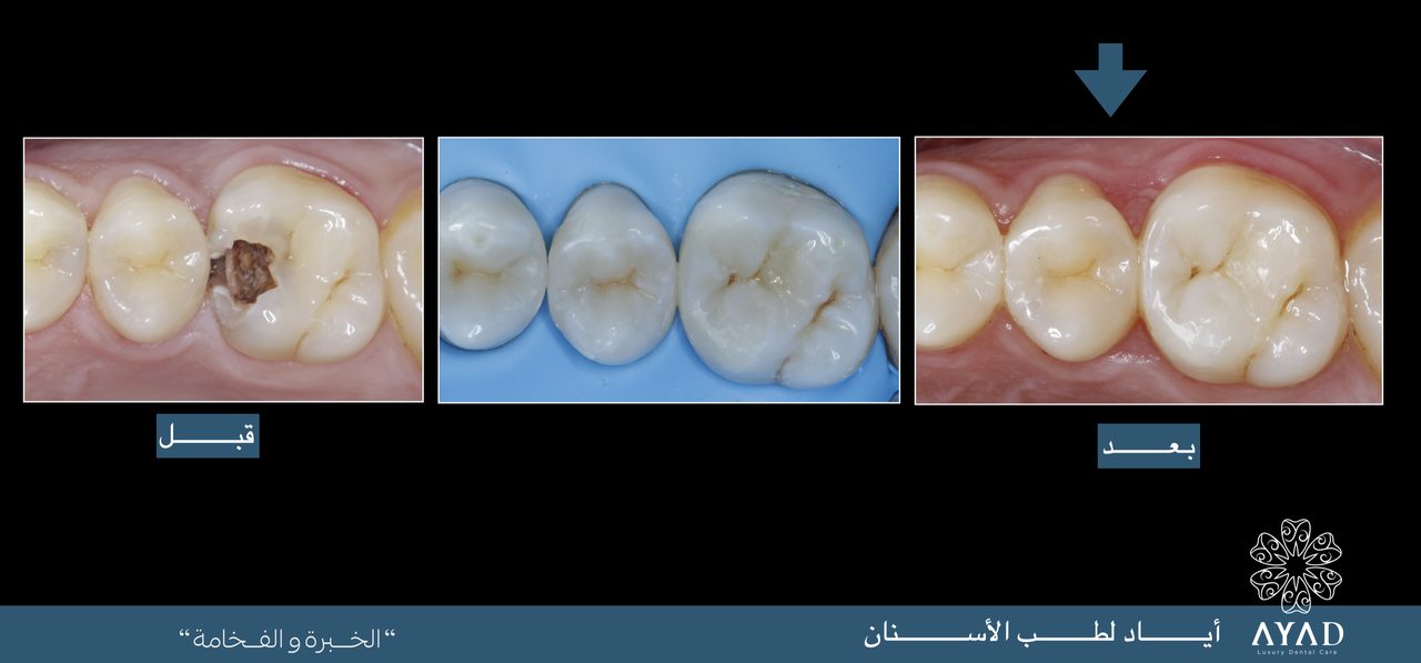 Case card — a decayed molar restored, the finished tooth marked with an arrow