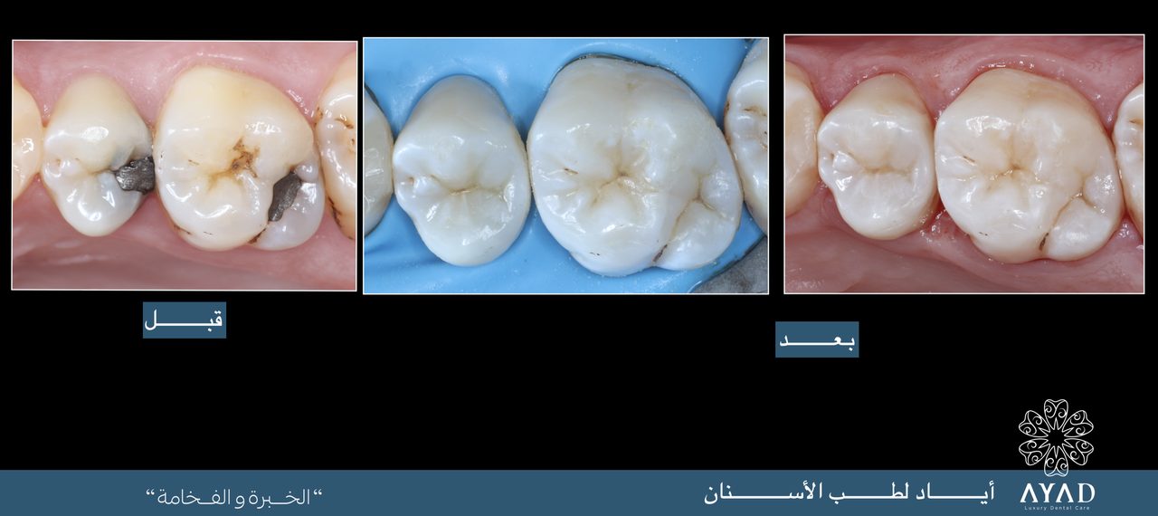 Case card — two molars restored, shown before, during and after