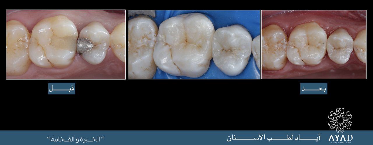 Case card — an old metal filling replaced, shown before, during and after
