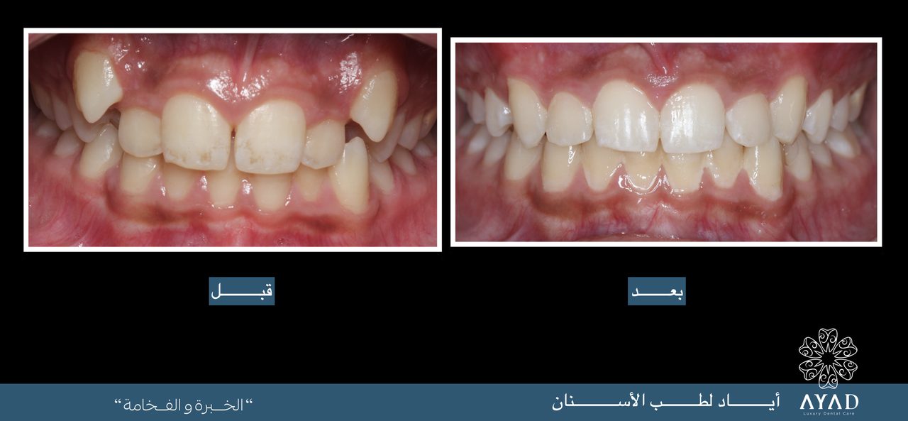 Case card — the upper and lower arches before and after treatment