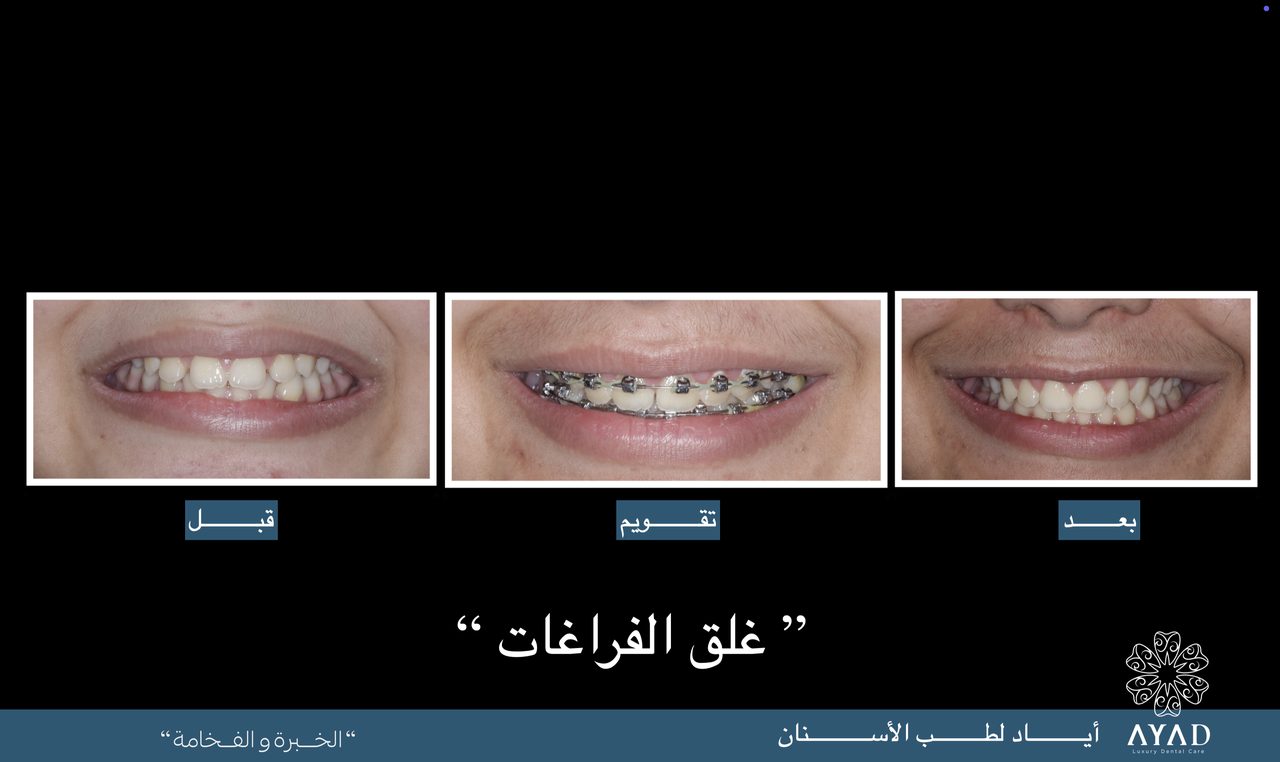 Case card — closing the gaps: the smile before, in braces, and after