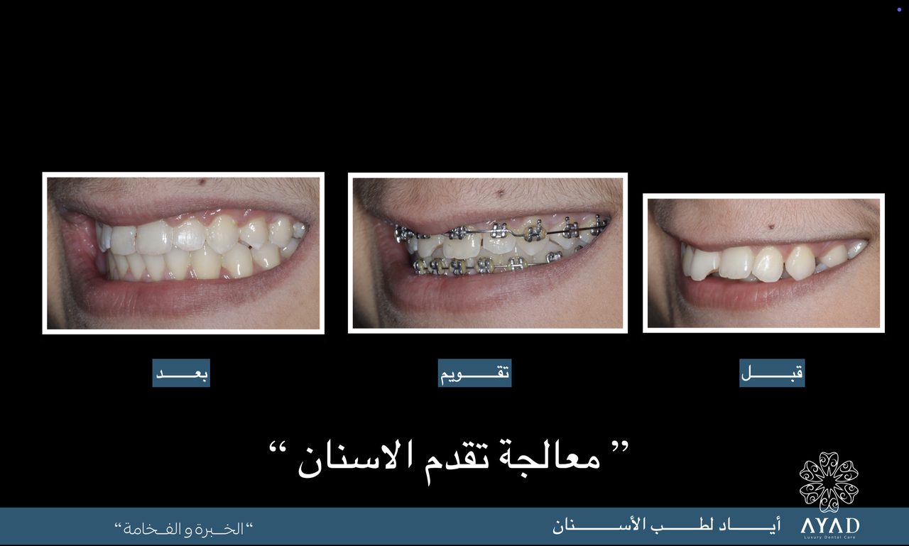 Case card — correcting protruding front teeth, before, in braces, and after