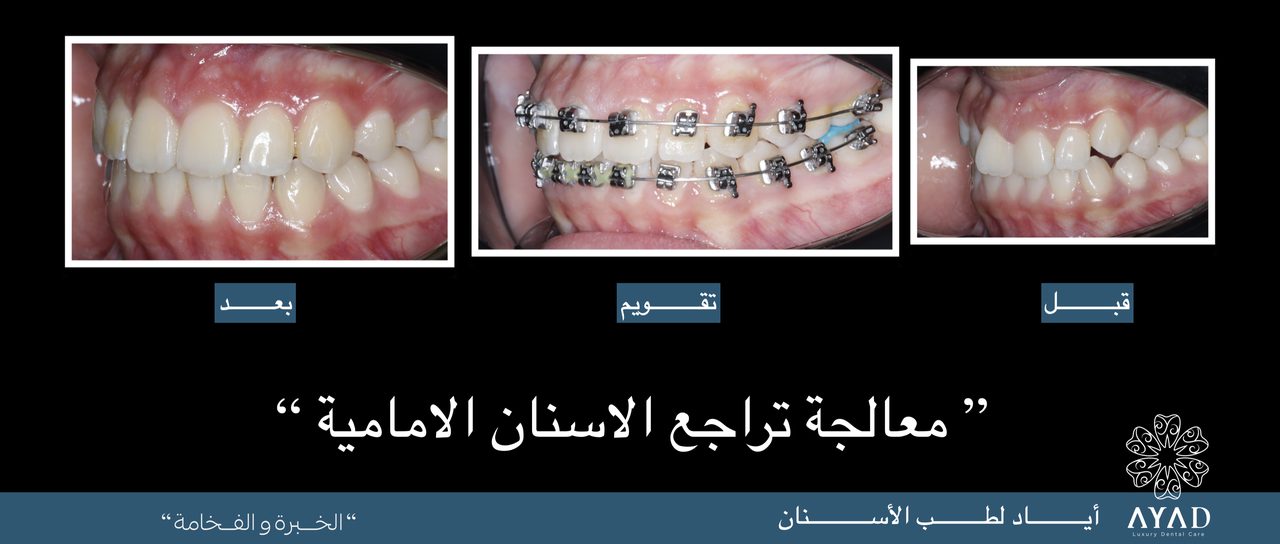 Case card — correcting retruded front teeth, before, in braces, and after