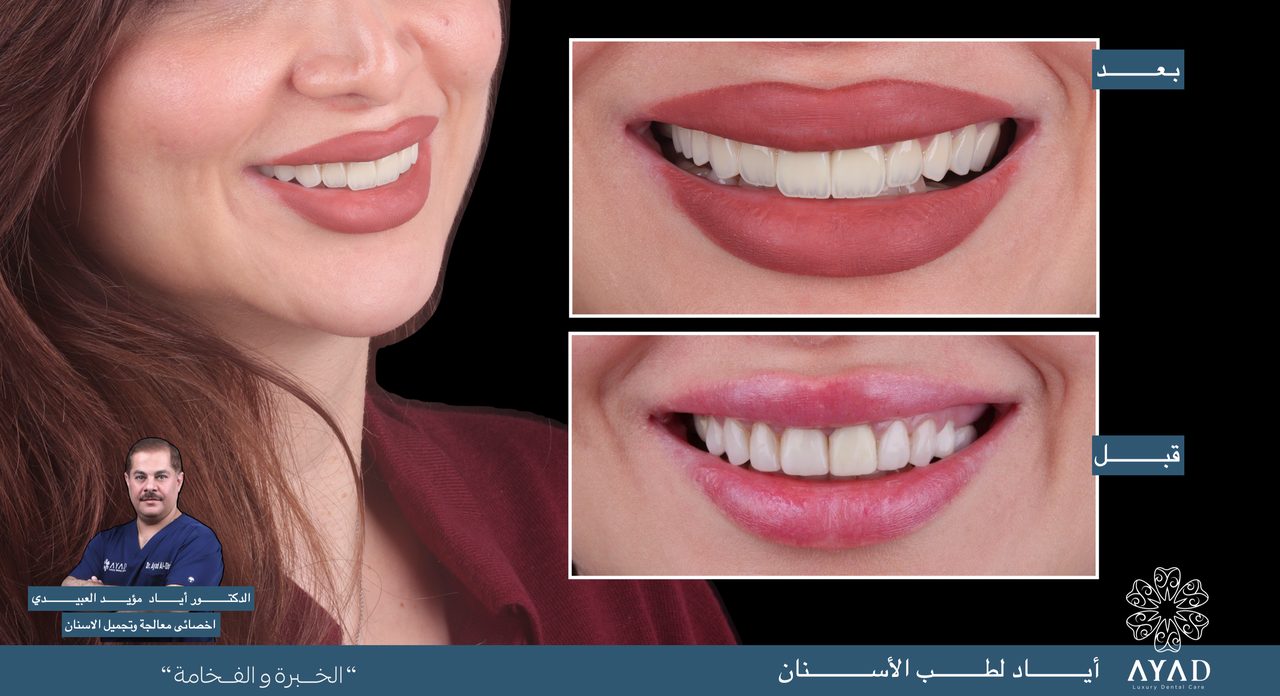 Case card — a patient photographed smiling, with before and after close studies