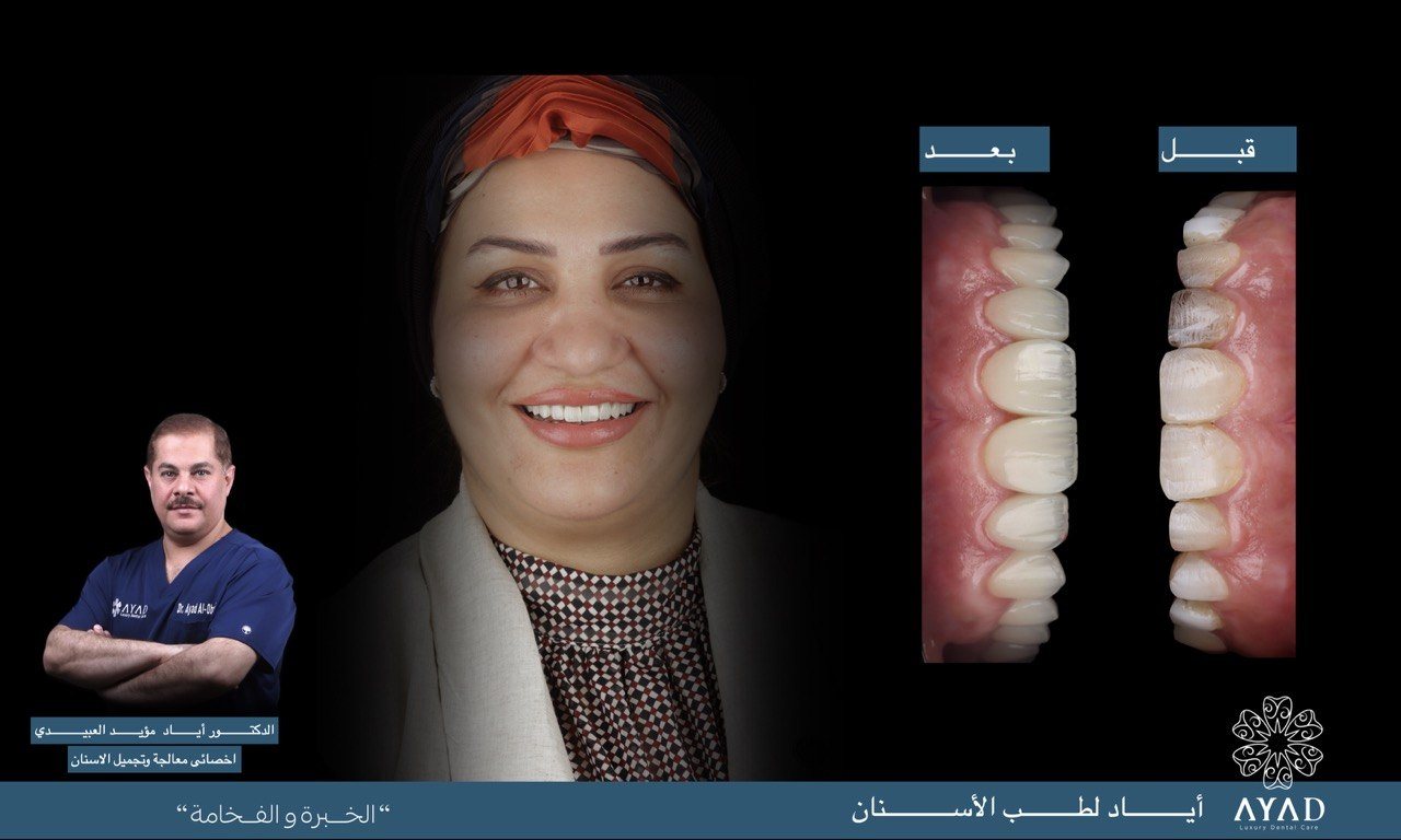 Case card — the upper arch before and after