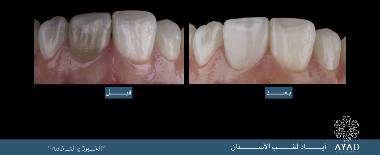 Case card — a close study of two upper front teeth, discoloured before and matched in ceramic after