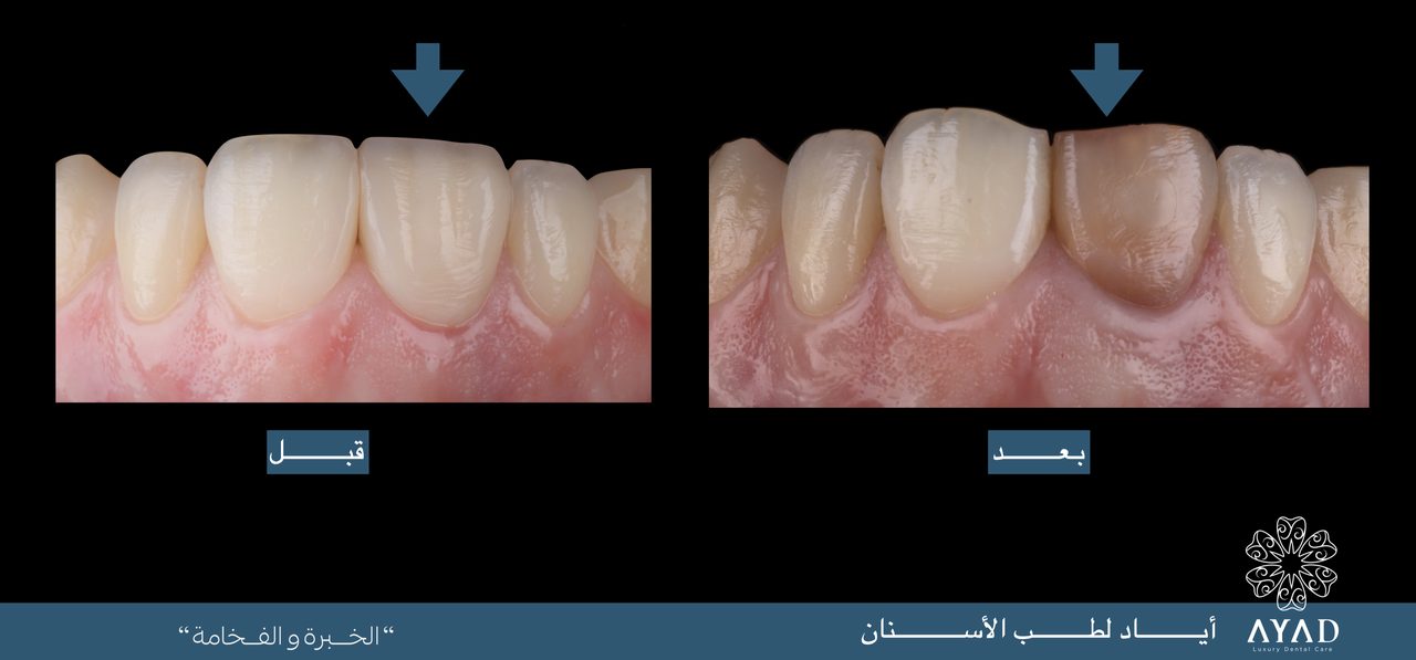 Case card — upper front teeth marked with arrows, before and after treatment