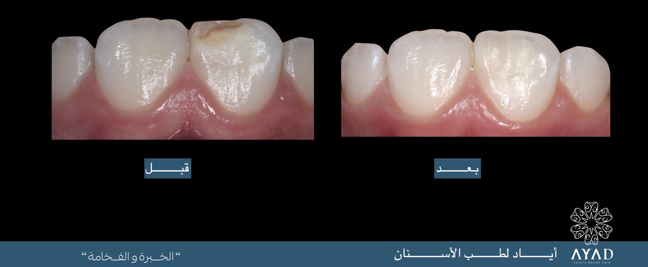 Case card — a broken upper central incisor rebuilt, shown before and after