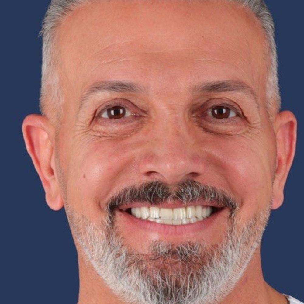 The same patient after treatment — an even ceramic smile