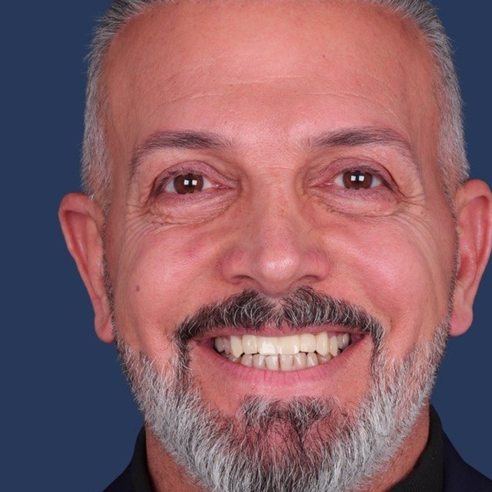 Patient before treatment — worn, uneven upper teeth