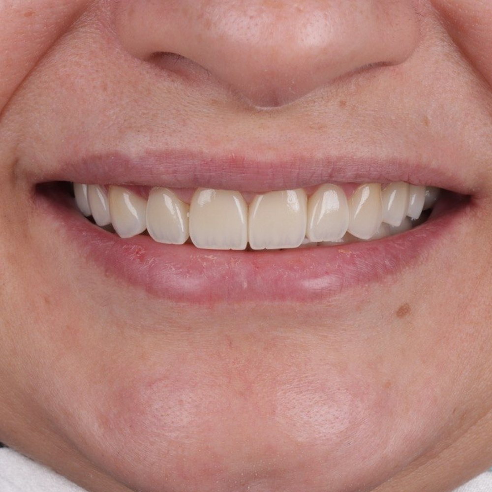 The same patient after treatment — a restored upper and lower arch