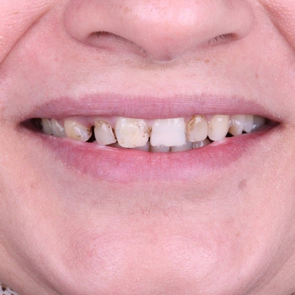Patient before treatment — decayed and broken teeth