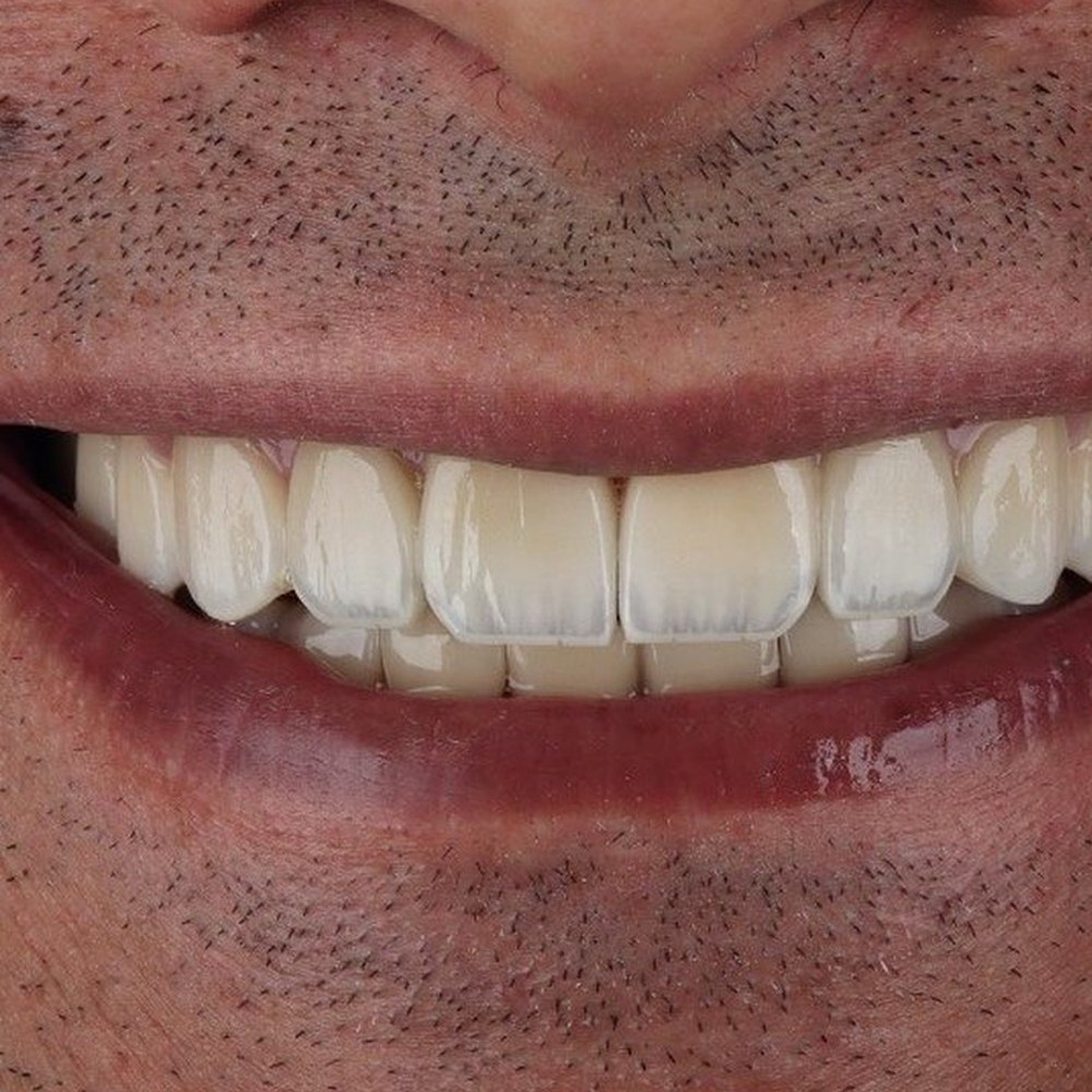 The same patient after treatment — the gap closed and the arch levelled