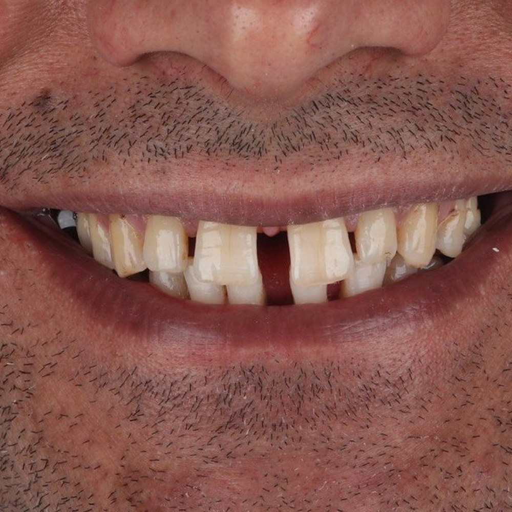 Patient before treatment — a missing tooth and an uneven smile line