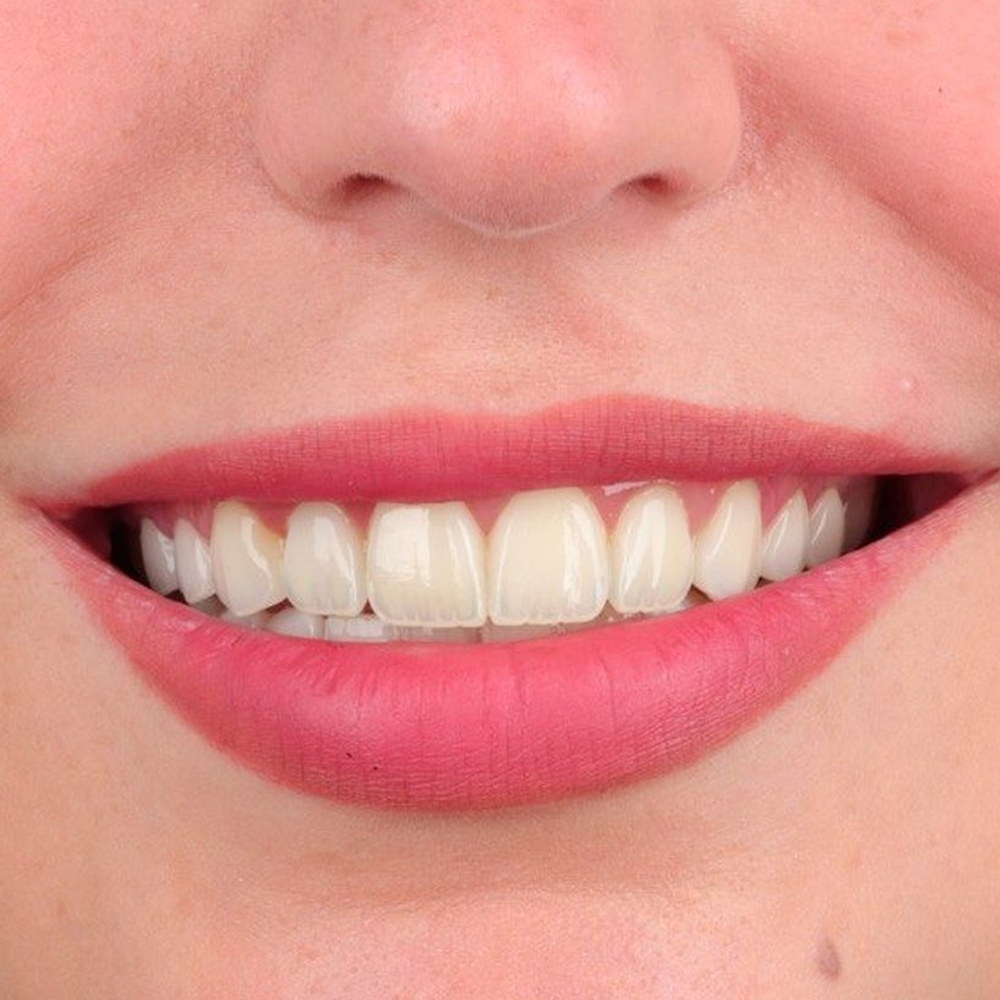 The same patient after treatment — an aligned, brighter smile