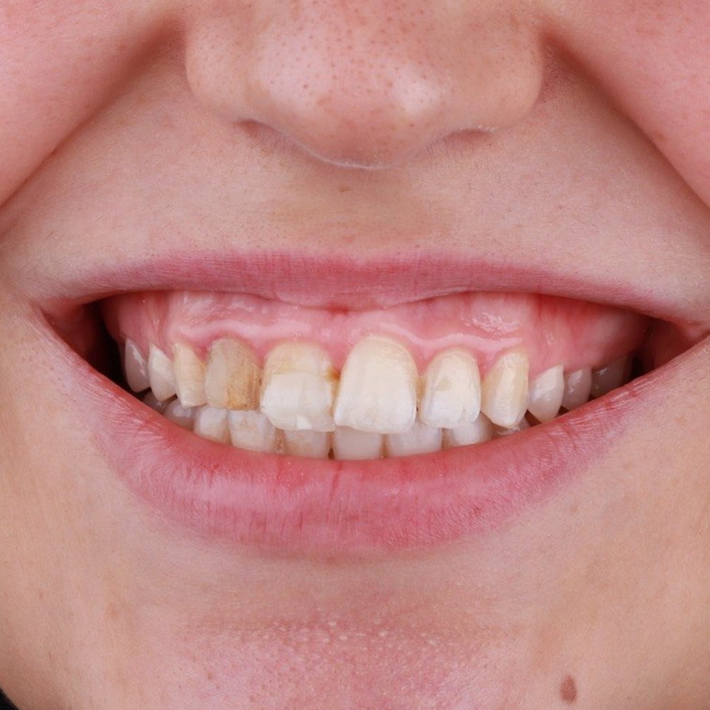 Patient before treatment — crowded, discoloured front teeth