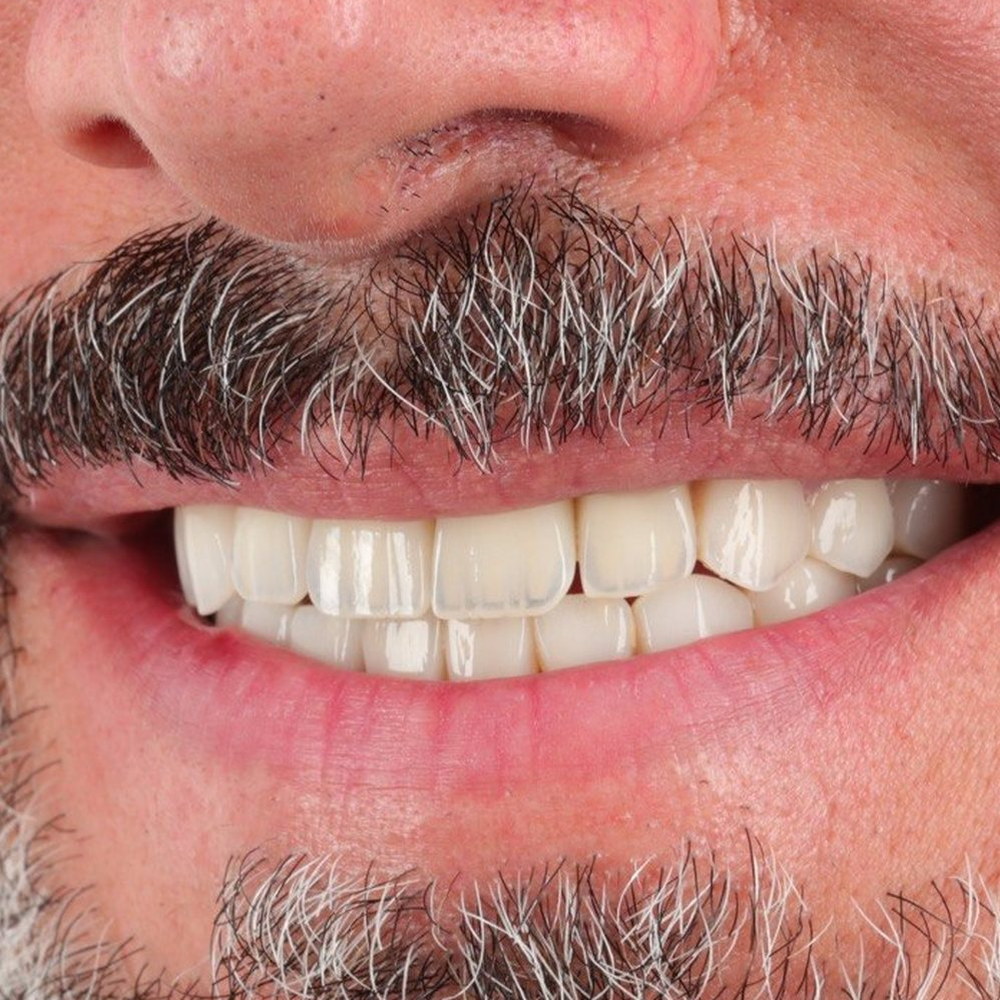 Close study after treatment — an even ceramic edge line